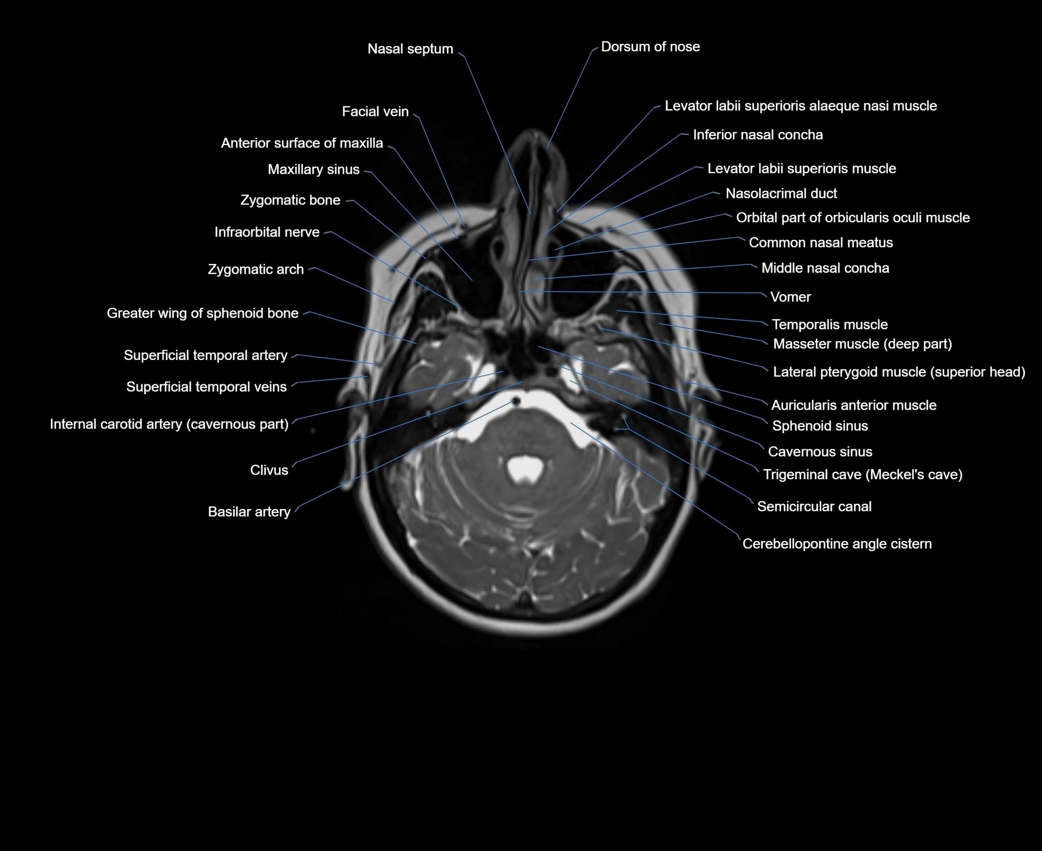 MRI Neck 3D labelled cross section anatomy axial 3t image-00001-00007.webp